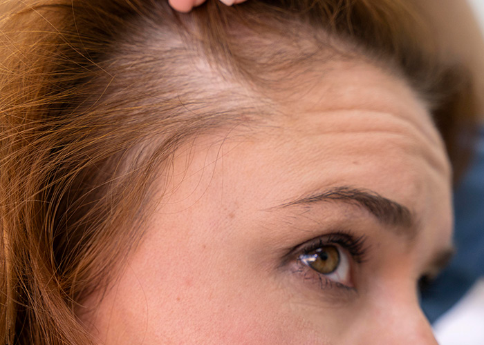 Alopecia é uma condição genética
