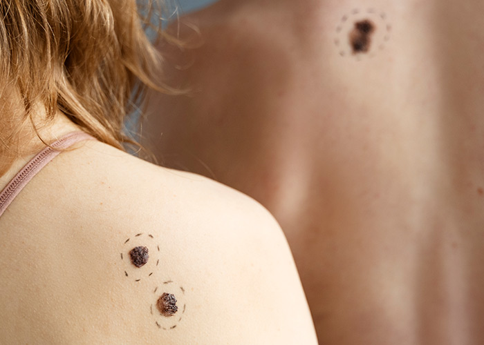 Terapia fotodinâmica no câncer de pele