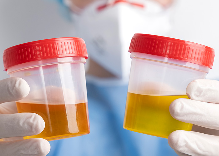 Cor da urina informa sobre a saúde