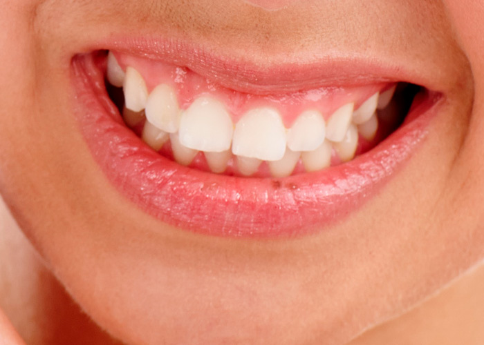 Cárie é a doença de alta prevalência mundial