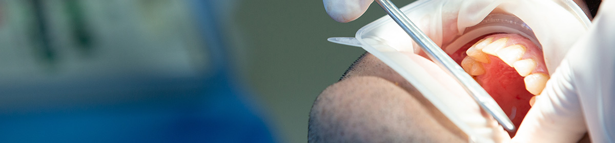 Estabilidade dos implantes dentários