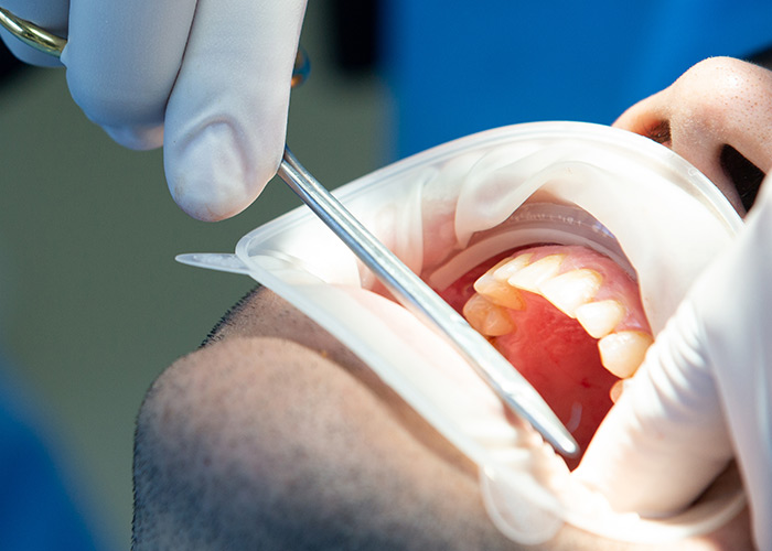 Estabilidade dos implantes dentários
