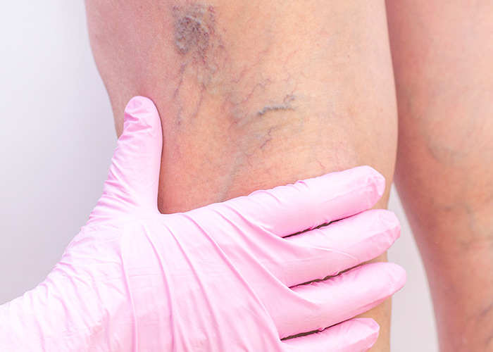 Com os avanços da medicina vascular ocorreu uma verdadeira revolução no tratamento de varizes, com soluções eficazes