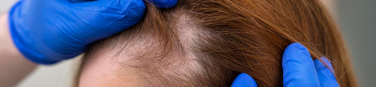 Alopecia areata