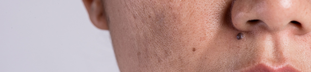 Manchas de melasma