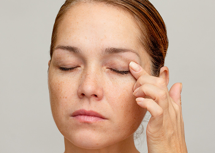 Excesso de pele das pálpebras