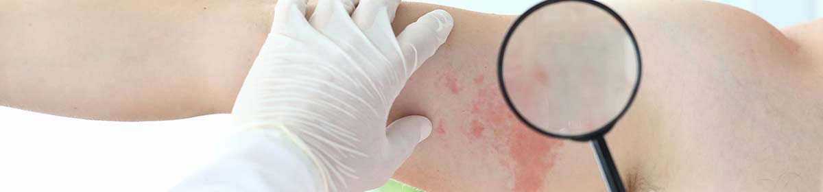 Diagnóstico da dermatite atópica