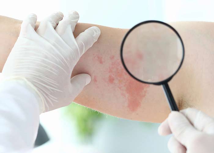 Diagnóstico da dermatite atópica