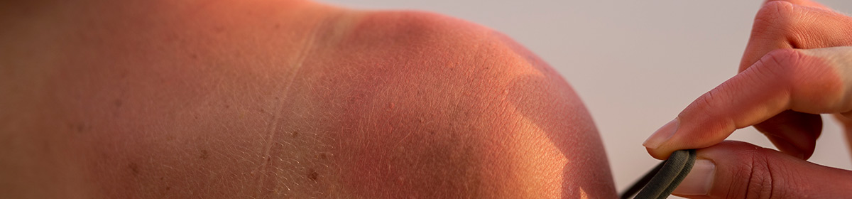 Fotoproteção da pele