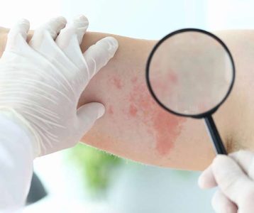 Diagnóstico da dermatite atópica