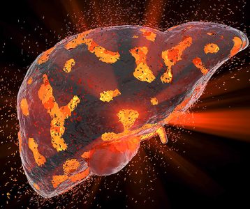 super-saudavel-materia-da-edicao-cirrose-pode-levar-a-falencia-total-do-figado Fígado é um órgão vital