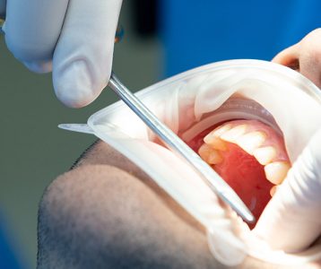 Estabilidade dos implantes dentários
