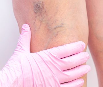 super-saudavel-tecnologia-a-revolucao-da-escleroterapia-sem-cirurgia Com os avanços da medicina vascular ocorreu uma verdadeira revolução no tratamento de varizes, com soluções eficazes