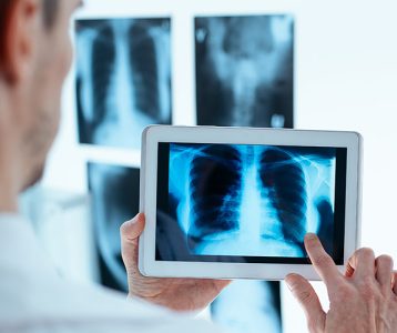 super-saudavel-tecnologia-microrrobos-biohibridos-no-tratamento-do-cancer-pulmonar Nanotecnologia e os microrrobôs