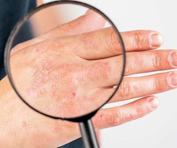 Pele ressecada e sensível