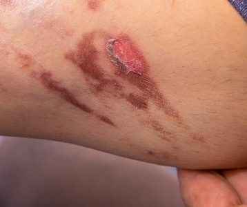 destaque-tecnologia-super-saudavel-oxigenoterapia-hiperbarica Oxigenoterapia hiperbárica é uma possibilidade de tratamento