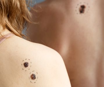 destaque-tecnologia-super-saudavel-terapia-fotodinamica-no-cancer-de-pele Terapia fotodinâmica no câncer de pele